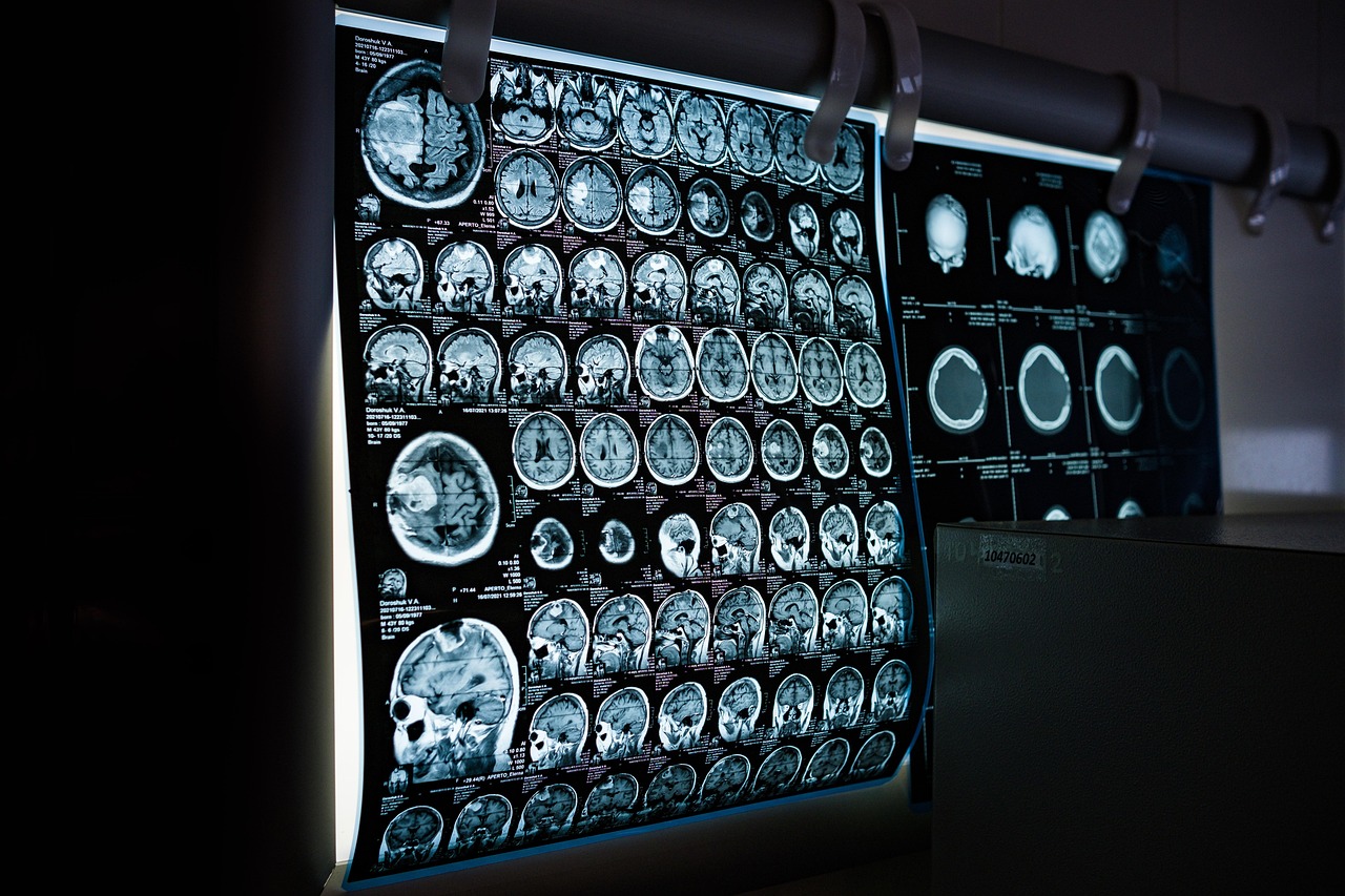 Cognitive Behavioral Therapy and Neuroplasticity: Structural Brain Changes in Adult Patients